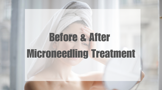 Things to Know Before & After Microneedling Treatment