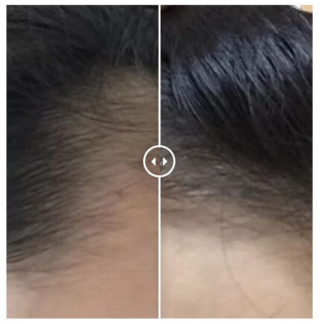 Before-and-after example showing visible changes along the hairline
