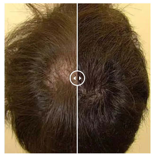 Before-and-after example showing visible changes at the crown