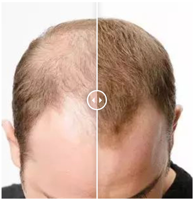 Before-and-after example showing visible changes in frontal scalp coverage